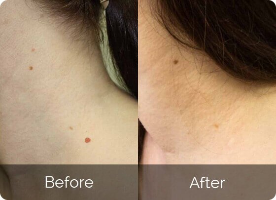 DermaRX Skin Tag Remover-reviews